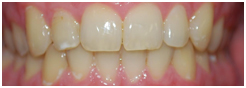 Tooth Whitening