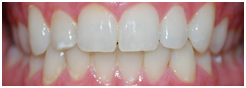 Tooth Whitening