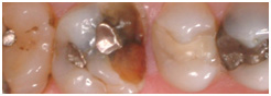 DENTAL CROWNS