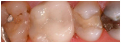 DENTAL CROWNS