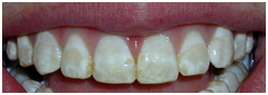 DENTAL VENEERS