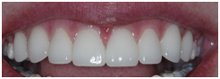 DENTAL VENEERS